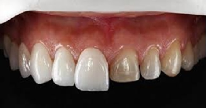 Rehabilitación Protésica